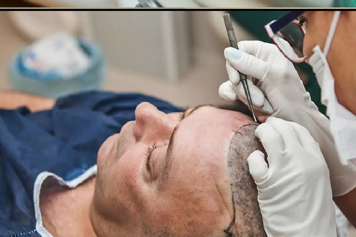 Hair Transplant 1