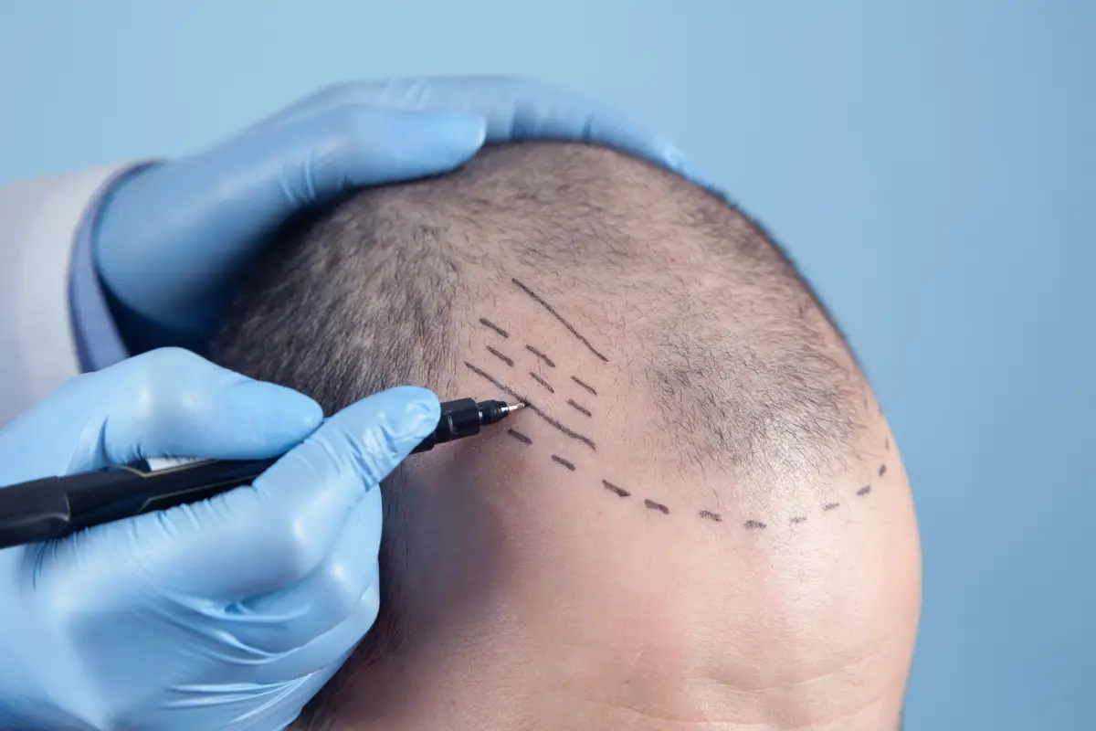 Hair Transplant 4