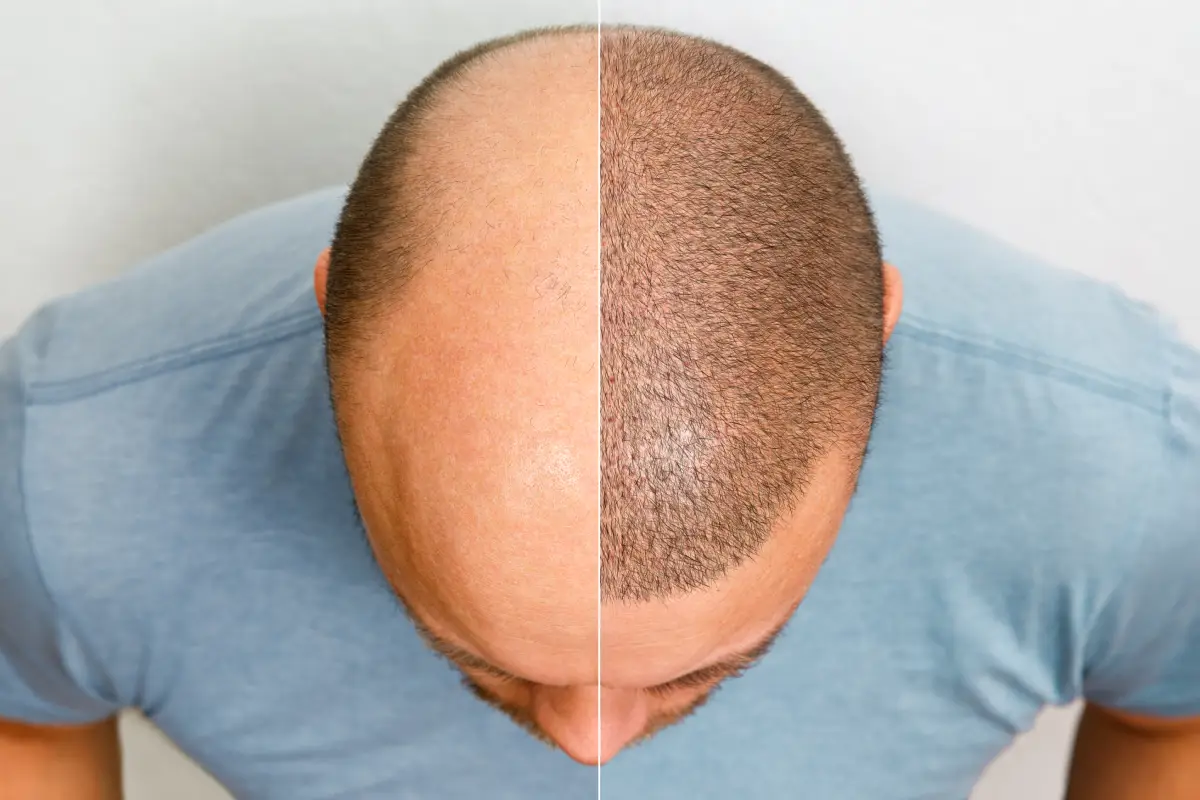 Hair Transplant 3